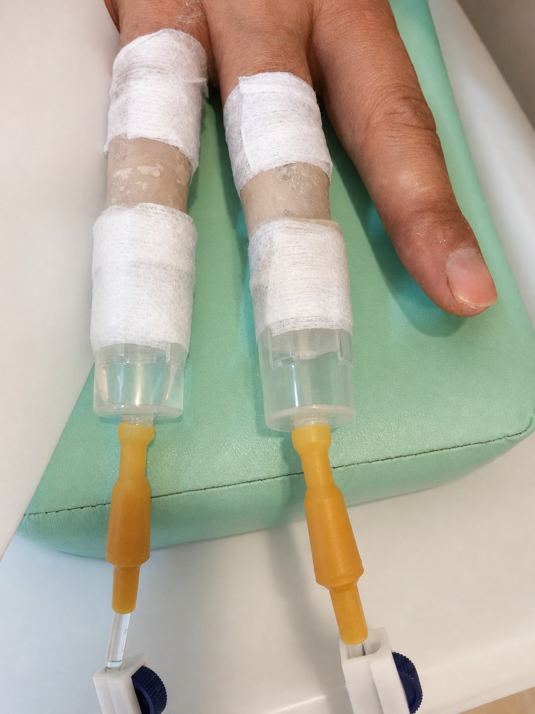 Historical fingertip treatment configuration using the Regeneratron device